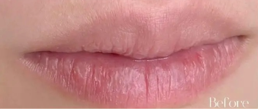 唇の施術前
