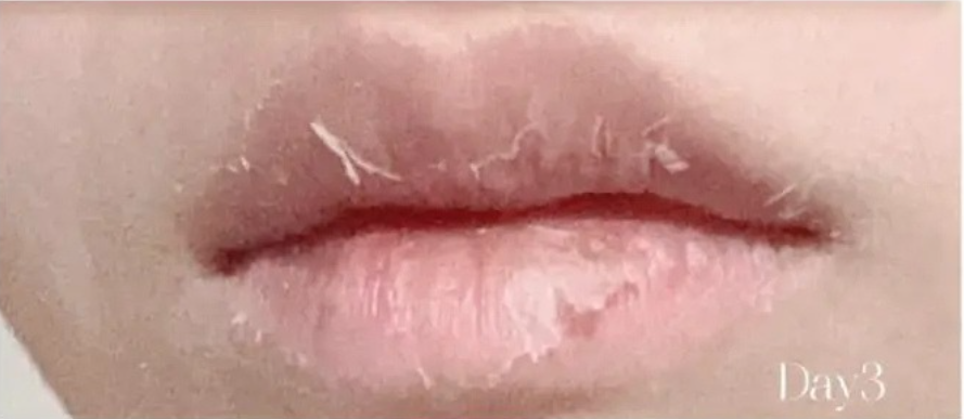 唇施術皮向け