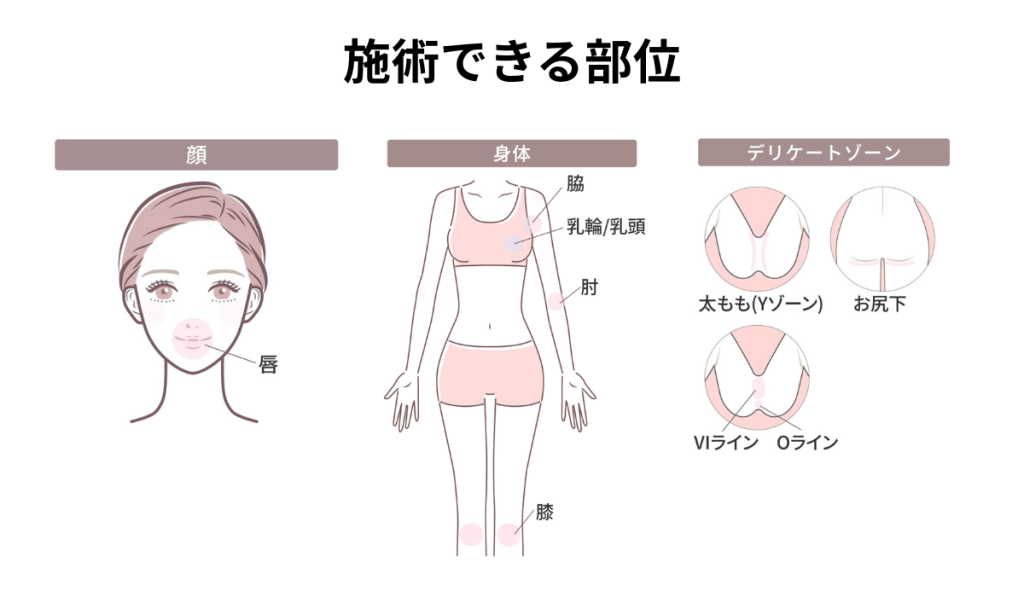 施術できる部位